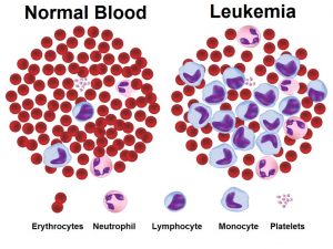 Leucemia acuta