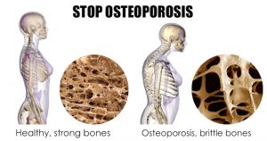 stop-osteoporosis